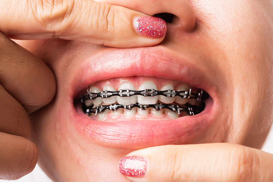 Your Age Doesn’t Have to Keep You from a Straighter Smile
