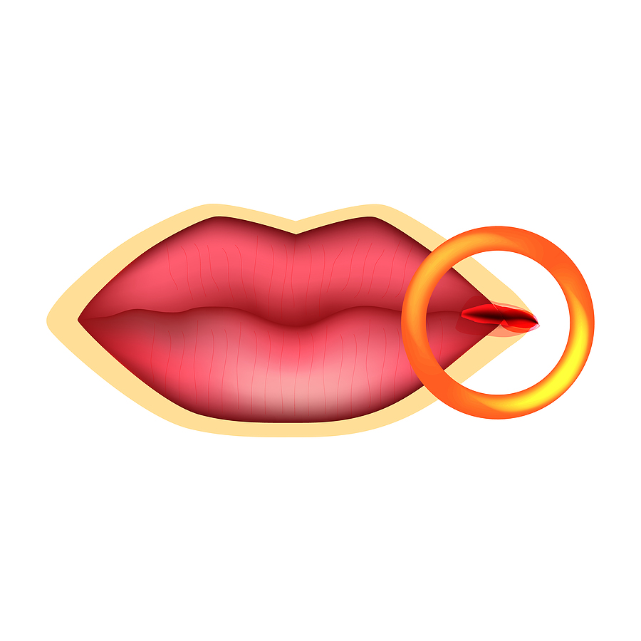 Put an End to Uncomfortable and Embarrassing Cracked Mouth Corners