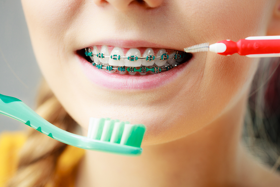 Practice Daily Hygiene to Avoid Gum Swelling While Wearing Braces