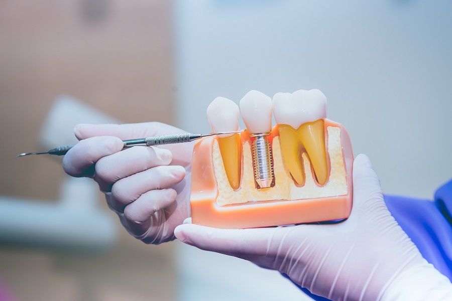 Do You Have Adequate Bone to Support an Implant