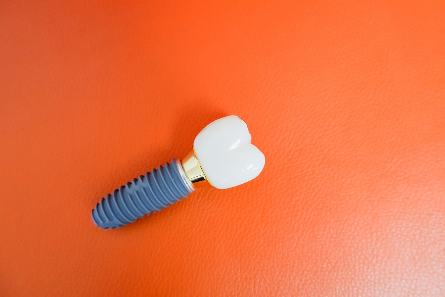 Dental Implants Could be Your Best Option to Replace Lost Teeth
