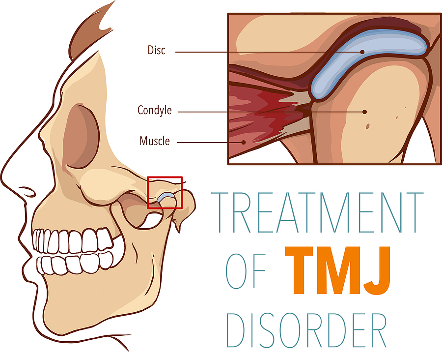 Understanding TMJ: Causes, Symptoms, and Treatment Options